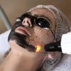 Lazerle-Karbon-Peeling-mersin